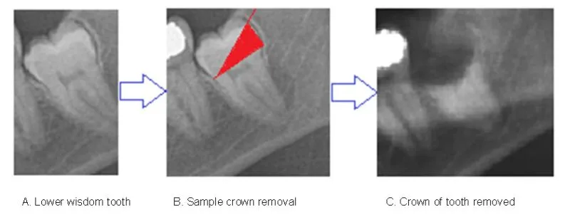 X-Rays showing a tooth receiving a coronectomy