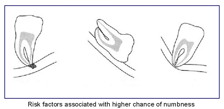 Diagram showing risk factors that might indicate that a coronectomy is the preferred treatment option